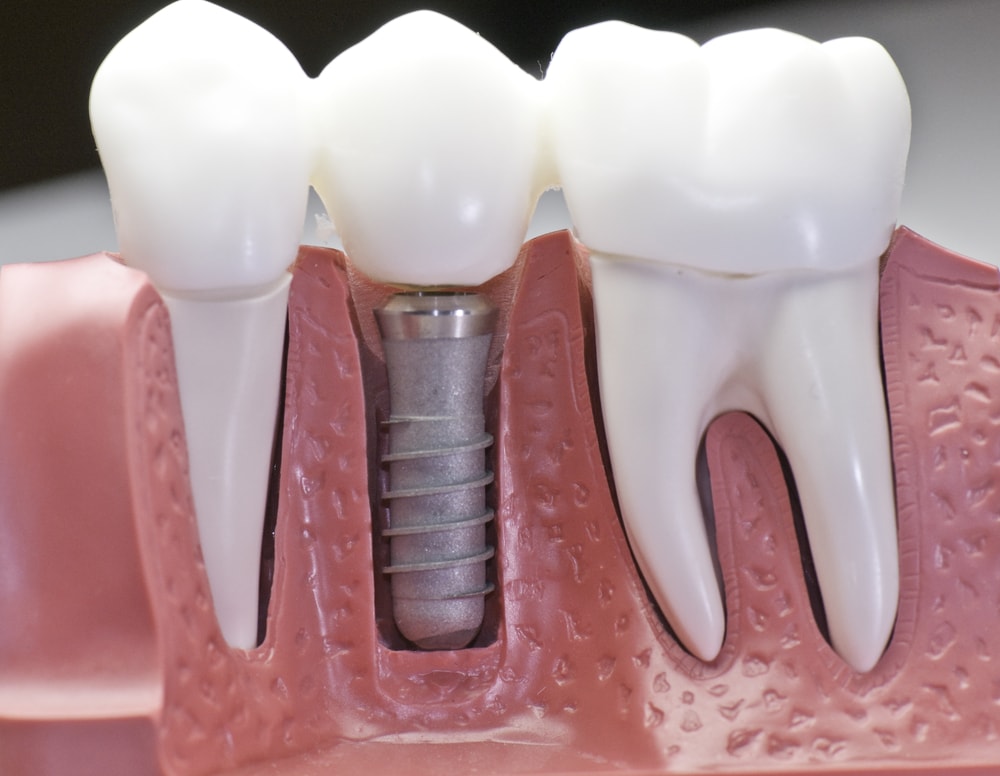 Dental Implants White Dentistry Nogales